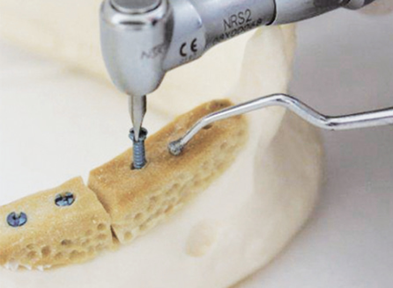 AP001 Bone block applicator - 1 pcs - Image 2