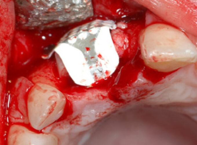 NeoGen™ Ti-Reinforced Membrane - M (Medium) 32 x 22 mm - Image 3