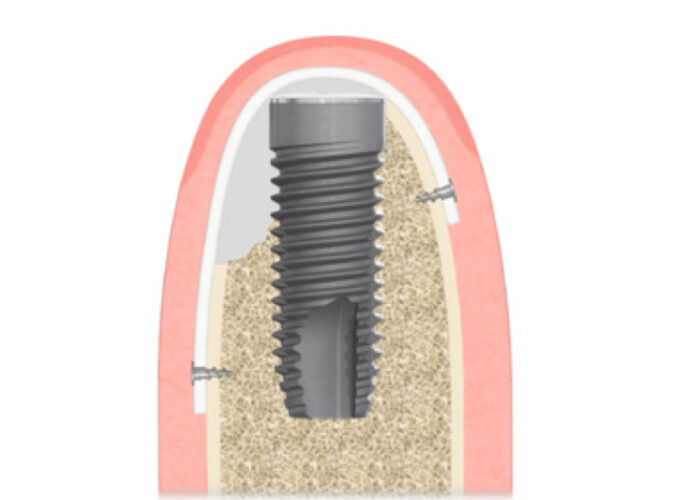 NeoGen™ Non-Reinforced Membrane - 29 x 14 mm - Image 3
