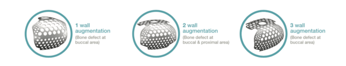 SmartBuilder titaniumsmembran, 1-sidet defekt - Image 10